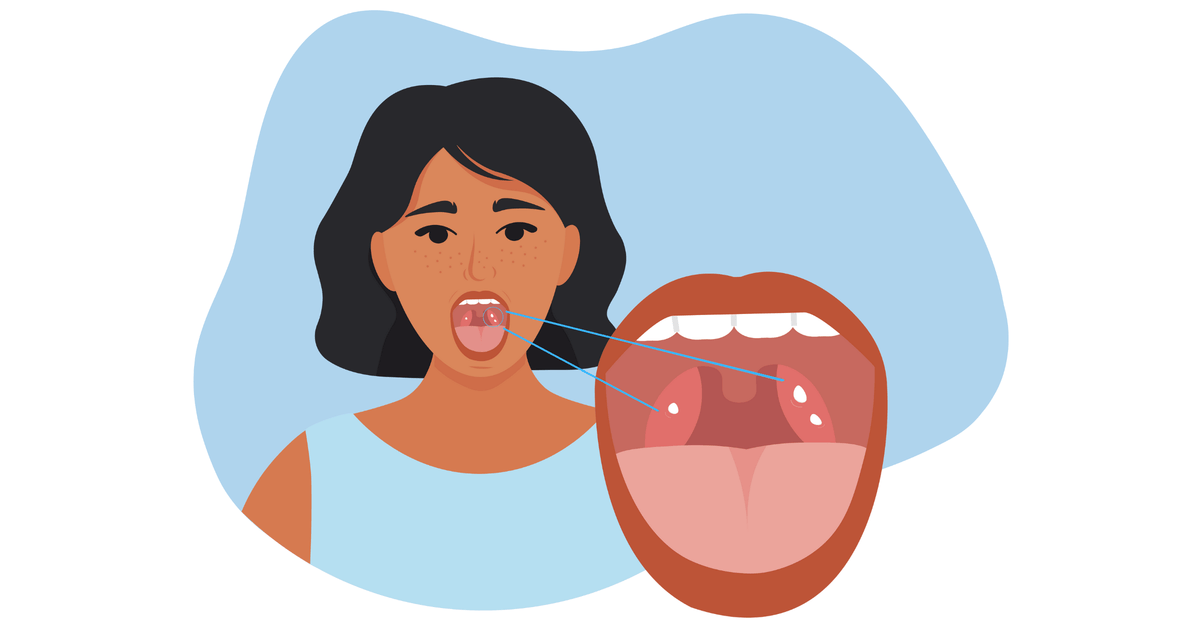 Tonsil Stones: 101
